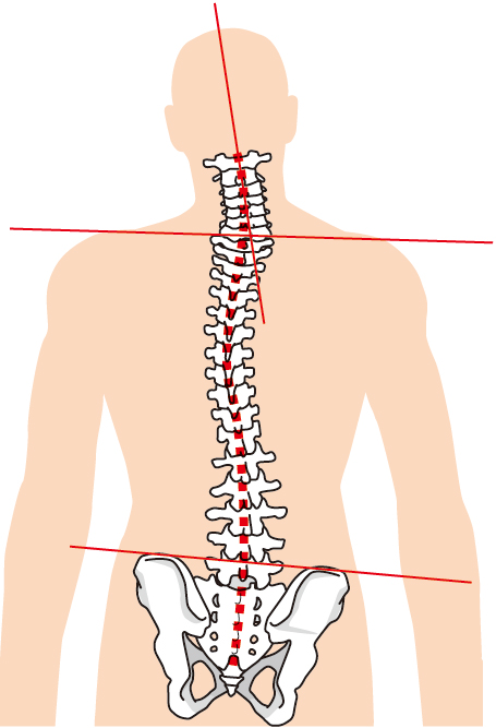 腰椎すべり症への当院のアプローチは？