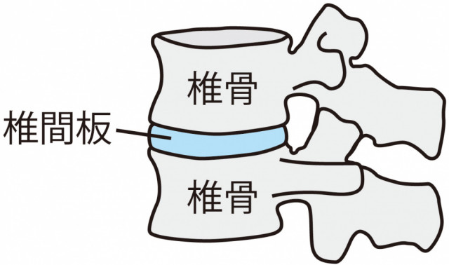 腰椎すべり症とは?