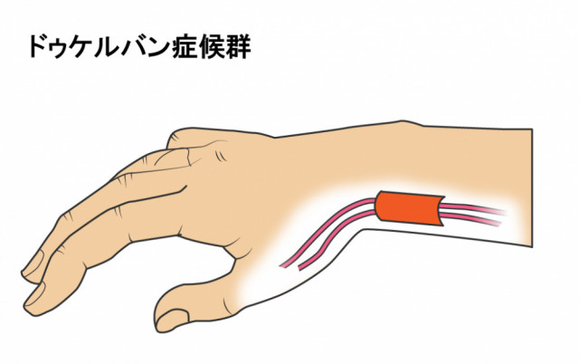 腱と腱鞘のイラスト